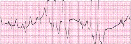 Identify the following rhythm (lead II): ____________________  <div style=padding-top: 35px> 