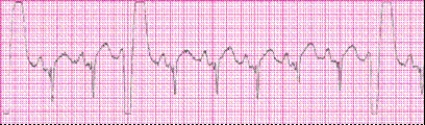 Identify the following rhythm (lead II): ____________________  <div style=padding-top: 35px> 