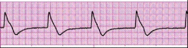 Identify the following rhythm (lead II): ____________________  <div style=padding-top: 35px> 
