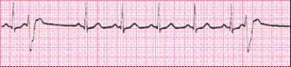 Identify the following rhythm (lead II): ____________________  <div style=padding-top: 35px> 