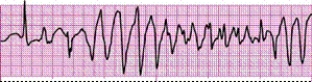Identify the following rhythm (lead II): ____________________  <div style=padding-top: 35px> 