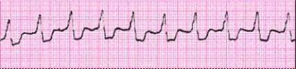 Identify the following rhythm (lead II): ____________________  <div style=padding-top: 35px> 