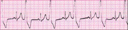 Identify the following rhythm (lead II): ____________________  <div style=padding-top: 35px> 