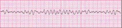 Identify the following rhythm (lead II): ____________________  <div style=padding-top: 35px> 