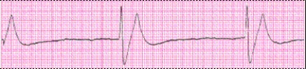 Identify the following rhythm (lead II): ____________________  <div style=padding-top: 35px> 