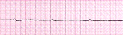 Identify the following rhythm (lead II): ____________________  <div style=padding-top: 35px> 