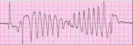 Identify the following rhythm (lead II): ____________________  <div style=padding-top: 35px> 