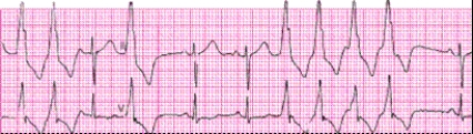 Identify the following rhythm: ____________________  <div style=padding-top: 35px> 