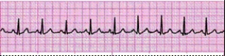 Identify the following rhythm (lead II): ____________________  <div style=padding-top: 35px> 