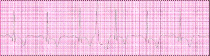 Identify the following rhythm (lead II): ____________________  <div style=padding-top: 35px> 