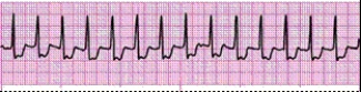 Identify the following rhythm (lead II): ____________________  <div style=padding-top: 35px> 