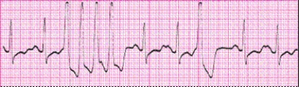 Identify the following rhythm (lead II): ____________________  <div style=padding-top: 35px> 