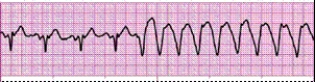 Identify the following rhythm (lead II): ____________________  <div style=padding-top: 35px> 