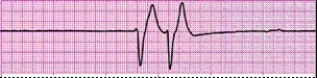 Identify the following rhythm (lead II): ____________________  <div style=padding-top: 35px> 