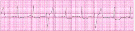 Identify the following rhythm (lead II): ____________________  <div style=padding-top: 35px> 