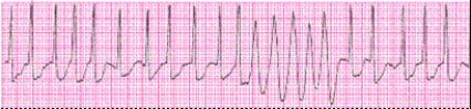 Identify the following rhythm (lead II): ____________________  <div style=padding-top: 35px> 