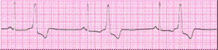 Identify the following rhythm (lead II): ____________________  <div style=padding-top: 35px> 
