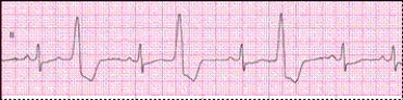 Identify the following rhythm: ____________________  <div style=padding-top: 35px> 