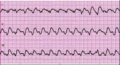 Identify the following rhythm: ____________________  <div style=padding-top: 35px> 
