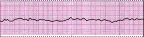 Identify the following rhythm (lead II): ____________________  <div style=padding-top: 35px> 