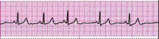 Identify the following rhythm (lead II): ____________________  <div style=padding-top: 35px> 