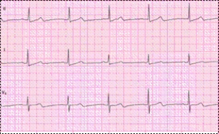Identify the following rhythm: ____________________  <div style=padding-top: 35px> 
