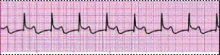 Identify the following rhythm (lead II): ____________________  <div style=padding-top: 35px> 