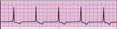 Identify the following rhythm (lead II): ____________________  <div style=padding-top: 35px> 