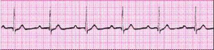 Identify the following rhythm: _________________________