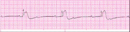 Identify the following rhythm: _________________________