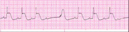 Identify the following rhythm: _________________________