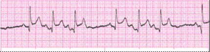 Identify the following rhythm: _________________________
