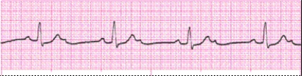 Identify the following rhythm: _________________________
