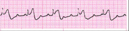 Identify the following rhythm: _________________________