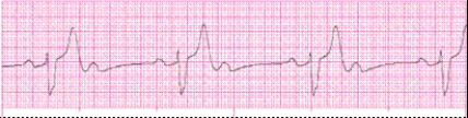 Identify the following rhythm: _________________________