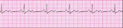 Identify the following rhythm: _________________________
