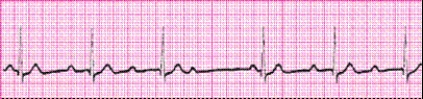 Identify the following rhythm: _________________________