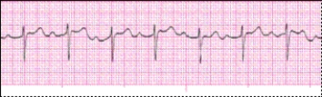 Identify the following rhythm: _________________________
