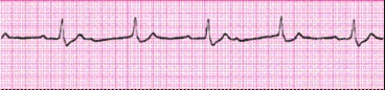 Identify the following rhythm: _________________________