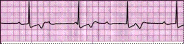 Identify the following rhythm: _________________________