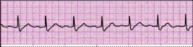 Identify the following rhythm: _________________________