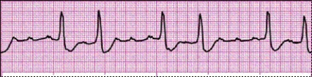 Identify the following rhythm: _________________________