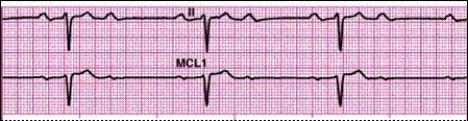 Identify the following rhythm: _________________________