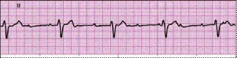 Identify the following rhythm: _________________________