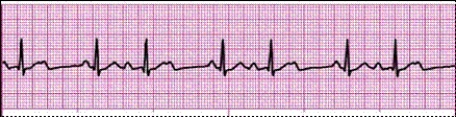 Identify the following rhythm: _________________________