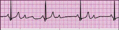 Identify the following rhythm: _________________________