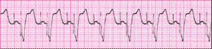 Identify the following rhythm: _________________________