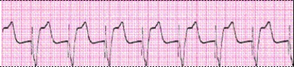 Identify the following rhythm: _________________________
