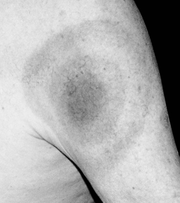 <strong>  The appearance of this rash is characteristic of infections with which of the following?</strong> A) Epstein-Barr virus B) Yersinia pestis C) Borrelia burgdorferi D) dengue virus E) Francisella tularensis <div style=padding-top: 35px> 