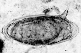 <strong>  A person reports to a clinic complaining of fever and abdominal pain. The abdomen is swollen, and blood tests indicate kidney damage. A stool sample is examined under a microscope and found to contain the egg shown in the figure. The indications are consistent with infection with</strong> A) Anaplasma phagocytophilium. B) Trypanosoma cruzi. C) Toxoplasma gondii. D) Schistosoma mansoni. E) Plasmodium falciparum. <div style=padding-top: 35px> 
